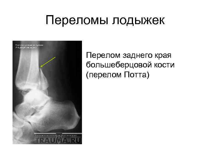 Переломы нижних конечностей презентация