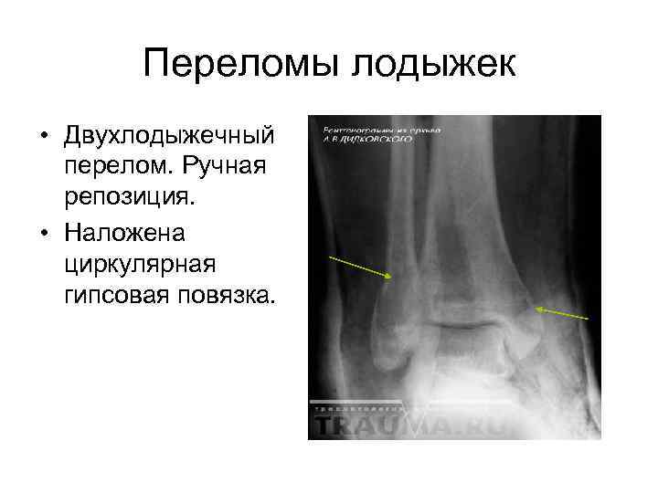 Трехлодыжечный перелом схема