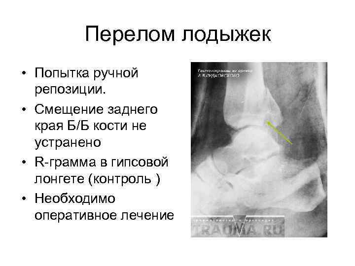 Переломы скуловой кости и дуги презентация