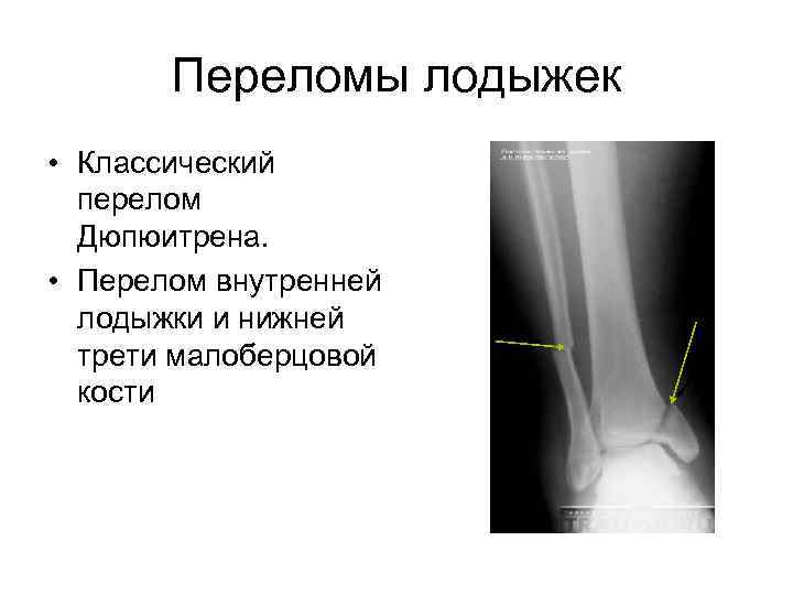 Переломы лодыжек • Классический перелом Дюпюитрена. • Перелом внутренней лодыжки и нижней трети малоберцовой