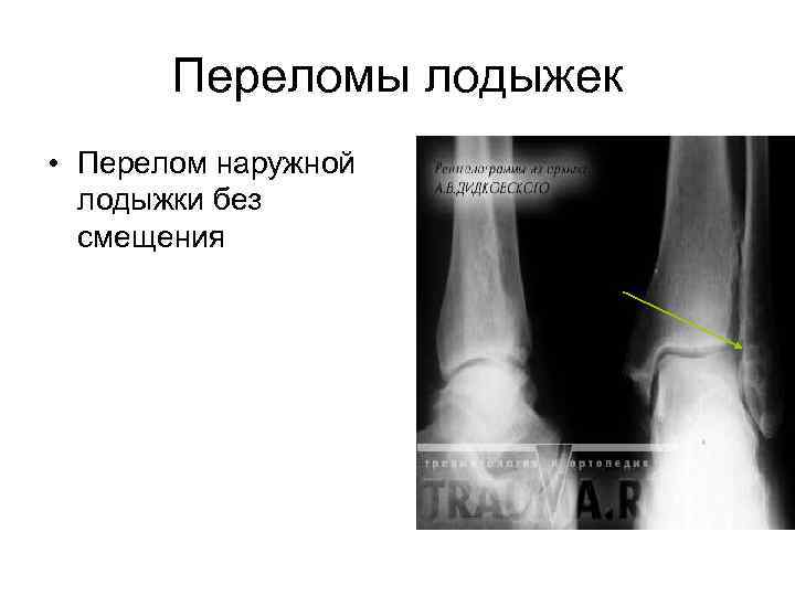 Закрытый перелом наружной лодыжки карта вызова скорой помощи