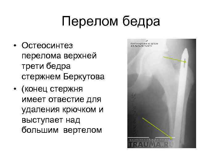 Перелом нижней трети бедренной кости. Перелом вертела бедренной кости. Перелом верхней трети бедра. Остеосинтез перелома верхней трети бедра. Классификация переломов верхней трети бедра.