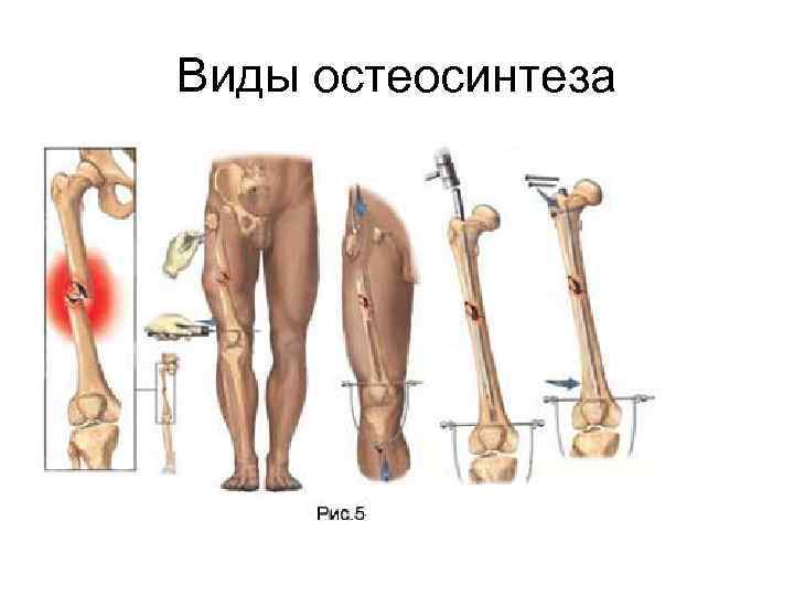 Переломы нижних конечностей презентация