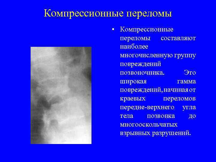 Компрессионные переломы • Компрессионные переломы составляют наиболее многочисленную группу повреждений позвоночника. Это широкая гамма