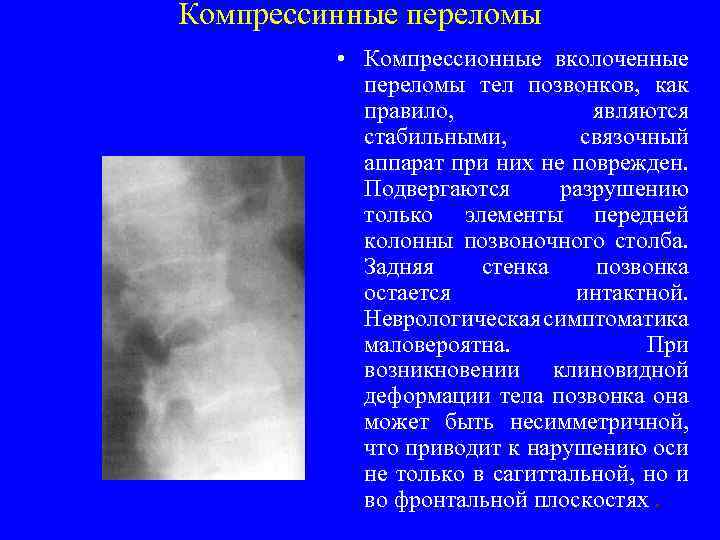 Компрессинные переломы • Компрессионные вколоченные переломы тел позвонков, как правило, являются стабильными, связочный аппарат