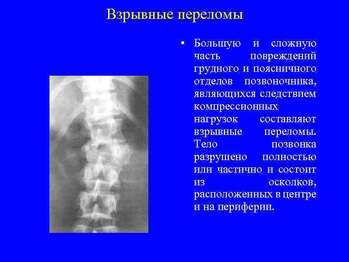 Перелом позвоночника отделы. Сгибательный перелом позвонка рентген. Взрывной перелом тела позвонка рентген. Взрывной оскольчатый перелом позвоночника. Компрессионный перелом позвоночника th12 l3.