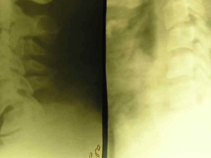 Перлом шейного отдела 