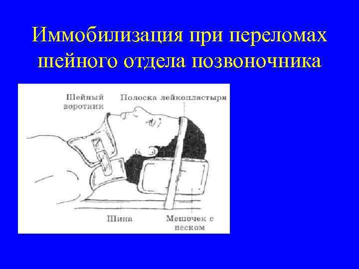 Фиксации положения. Травма шейного отдела позвоночника иммобилизация. Транспортная иммобилизация при переломе головы и шеи. Транспортная иммобилизация при переломе шейного отдела позвоночника. Иммобилизация при переломе отдела позвоночника.