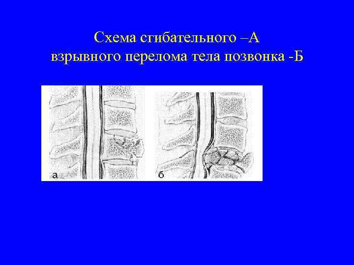 Схема сгибательного –А взрывного перелома тела позвонка -Б 