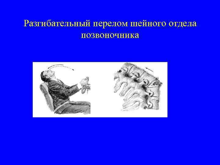 Разгибательный перелом шейного отдела позвоночника 