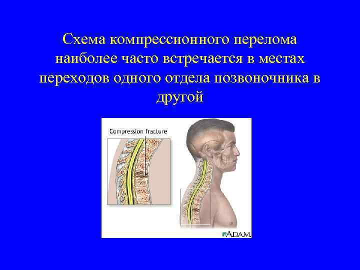 Схема компрессионного перелома наиболее часто встречается в местах переходов одного отдела позвоночника в другой