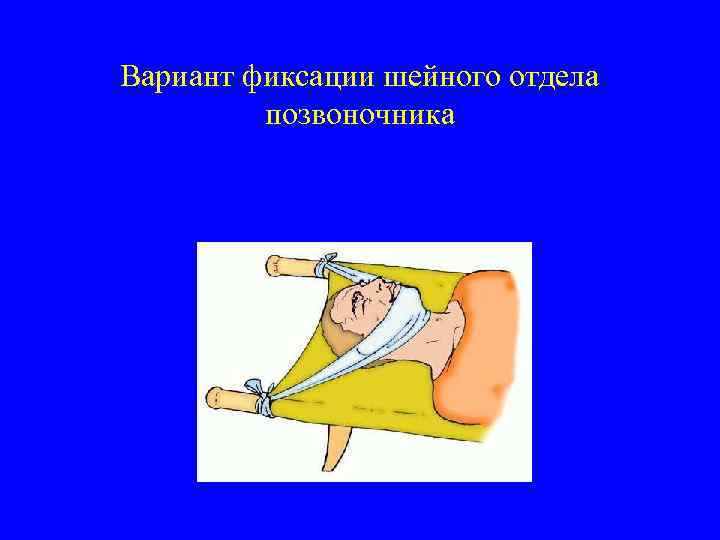 Вариант фиксации шейного отдела позвоночника 