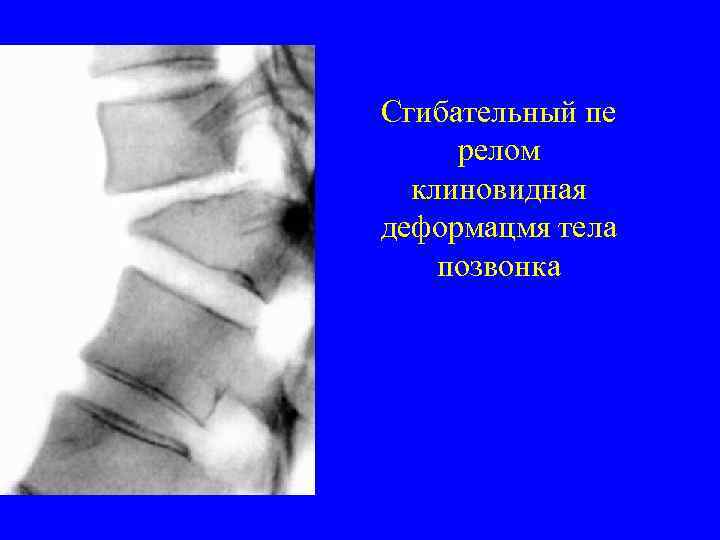 Сгибательный пе релом клиновидная деформацмя тела позвонка 