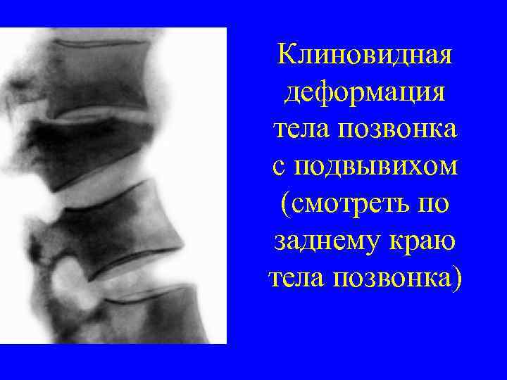 Клиновидная деформация тела позвонка с подвывихом (смотреть по заднему краю тела позвонка) 