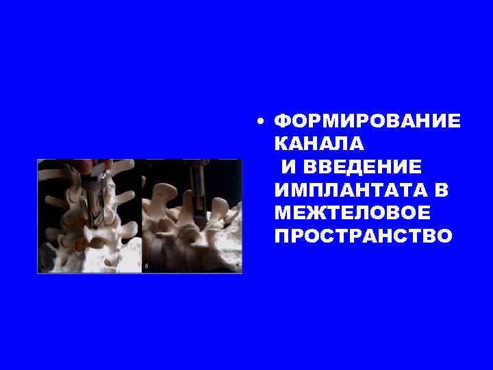  • ФОРМИРОВАНИЕ КАНАЛА И ВВЕДЕНИЕ ИМПЛАНТАТА В МЕЖТЕЛОВОЕ ПРОСТРАНСТВО 