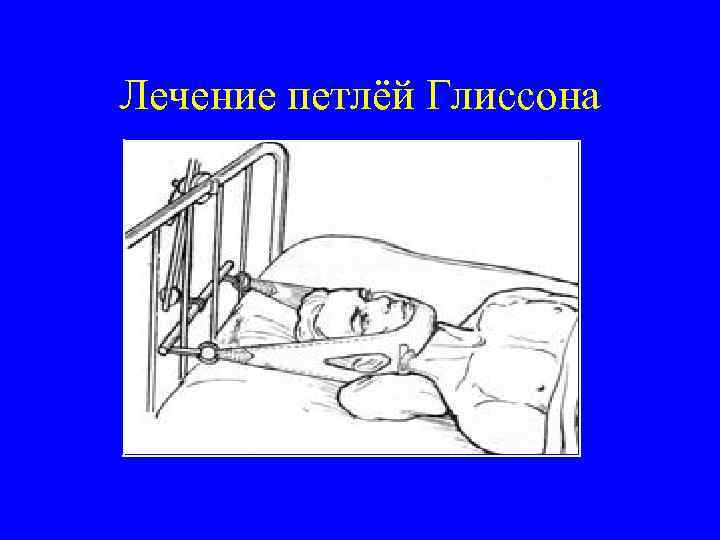 Петля глиссона чертеж