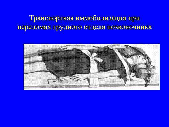 Перелом грудного отдела позвоночника. Иммобилизация при переломе грудного отдела позвоночника. При переломе позвоночника грудной отдел. Иммобилизация при переломе отдела позвоночника. Транспортировка при переломе грудного отдела позвоночника.