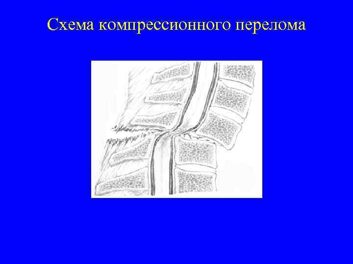 Схема компрессионного перелома 