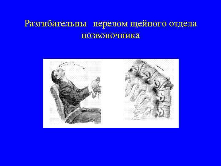 Разгибательны перелом щейного отдела позвоночника 