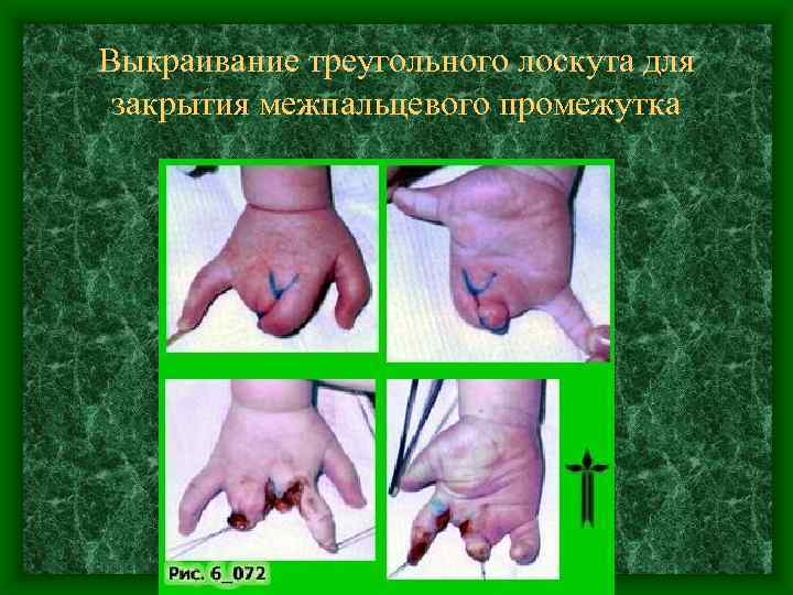 Выкраивание треугольного лоскута для закрытия межпальцевого промежутка 