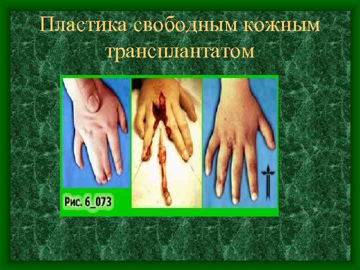 Пластика свободным кожным трансплантатом 