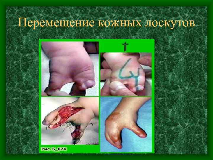 Перемещение кожных лоскутов 