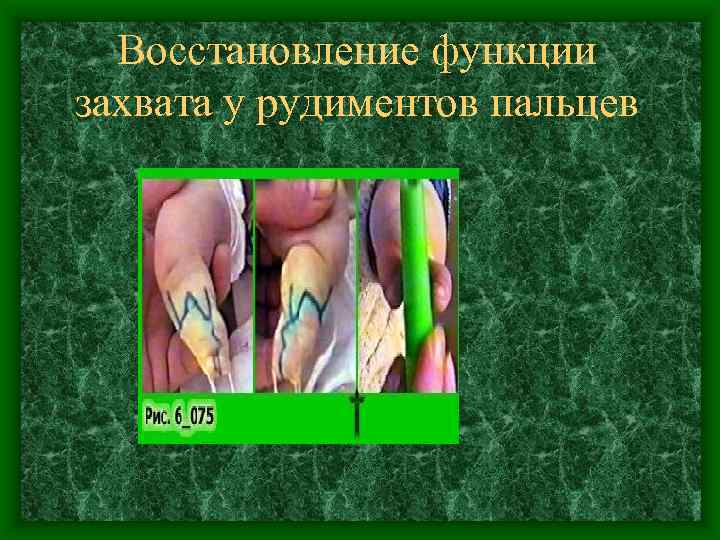 Восстановление функции захвата у рудиментов пальцев 