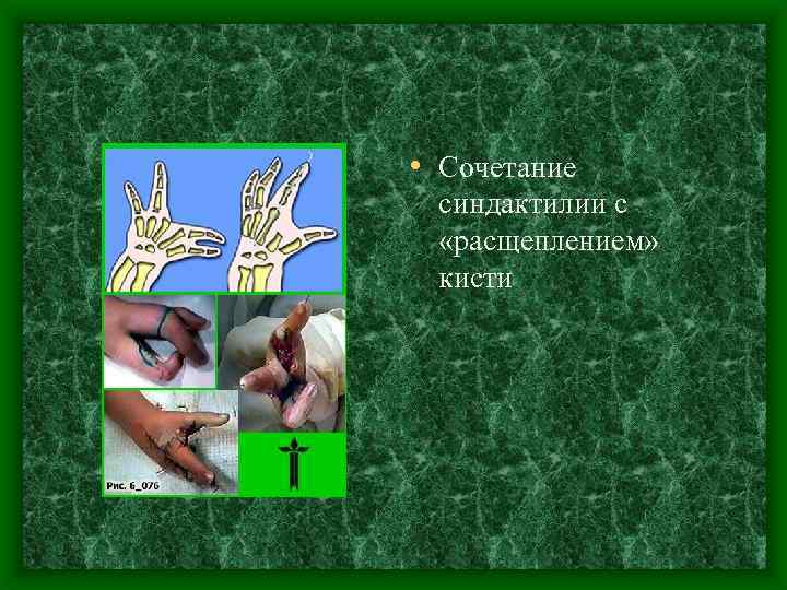  • Сочетание синдактилии с «расщеплением» кисти 