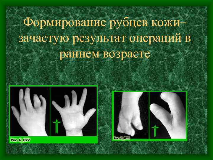 Формирование рубцев кожи– зачастую результат операций в раннем возрасте 