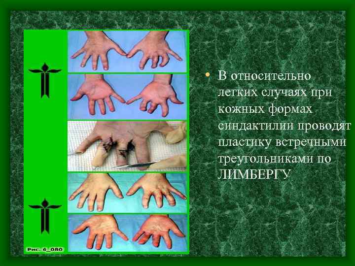  • В относительно легких случаях при кожных формах синдактилии проводят пластику встречными треугольниками