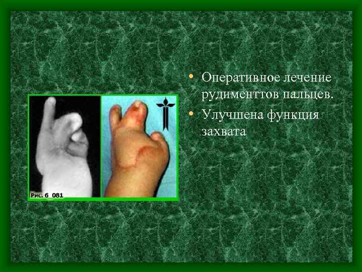 • Оперативное лечение рудименттов пальцев. • Улучшена функция захвата 