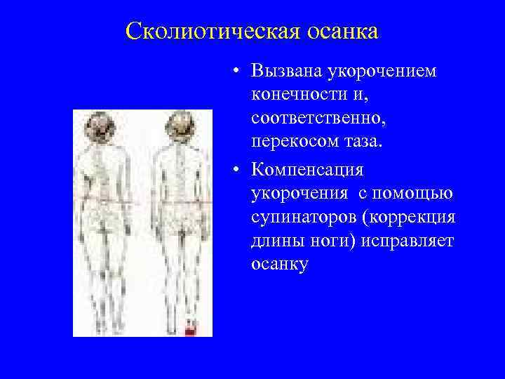 Сколиотическая осанка • Вызвана укорочением конечности и, соответственно, перекосом таза. • Компенсация укорочения с