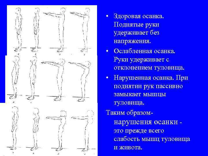  • Здоровая осанка. Поднятые руки удерживает без напряжения. • Ослабленная осанка. Руки удерживает