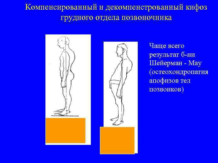 Компенсированный и декомпенстрованный кифоз грудного отдела позвоночника Чаще всего результат б-ни Шейерман - Мау