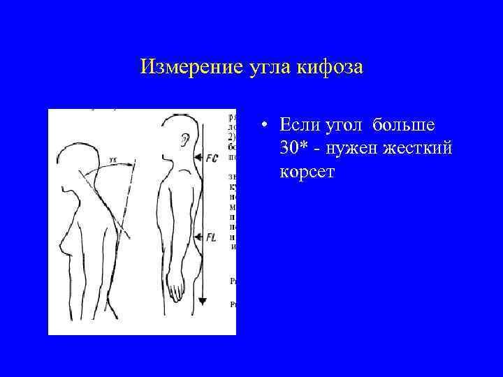 Измерение угла кифоза • Если угол больше 30* - нужен жесткий корсет 
