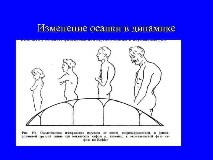 Изменение осанки в динамике 