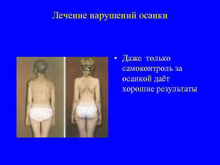 Лечение нарушений осанки • Даже только самоконтроль за осанкой даёт хорошие результаты 