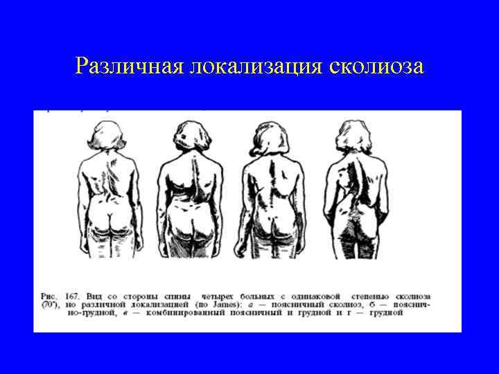 Различная локализация сколиоза 
