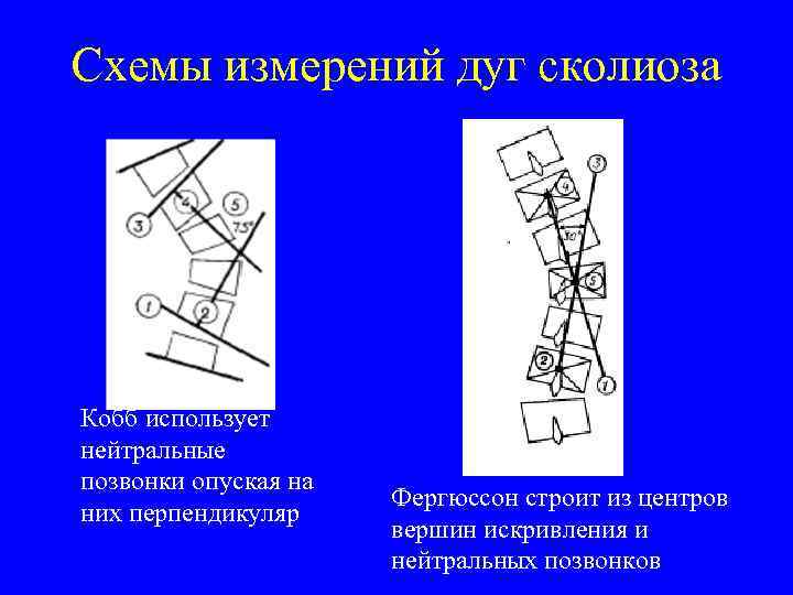 Схемы измерений дуг сколиоза Кобб использует нейтральные позвонки опуская на них перпендикуляр Фергюссон строит