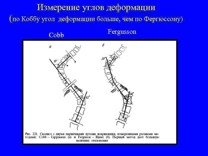 Измерение углов деформации (по Коббу угол деформации больше, чем по Фергюссону) Cobb Fergusson 