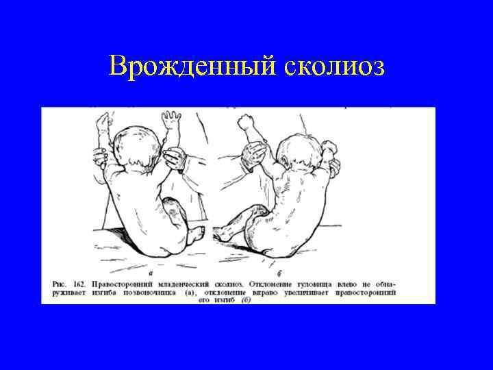 Врожденный сколиоз 