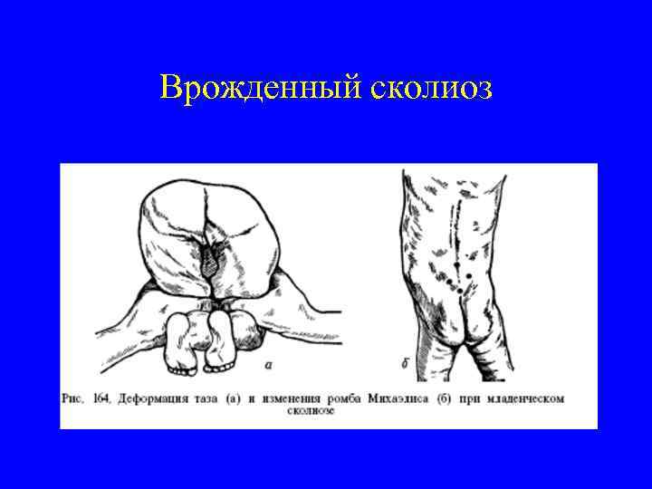 Врожденный сколиоз 