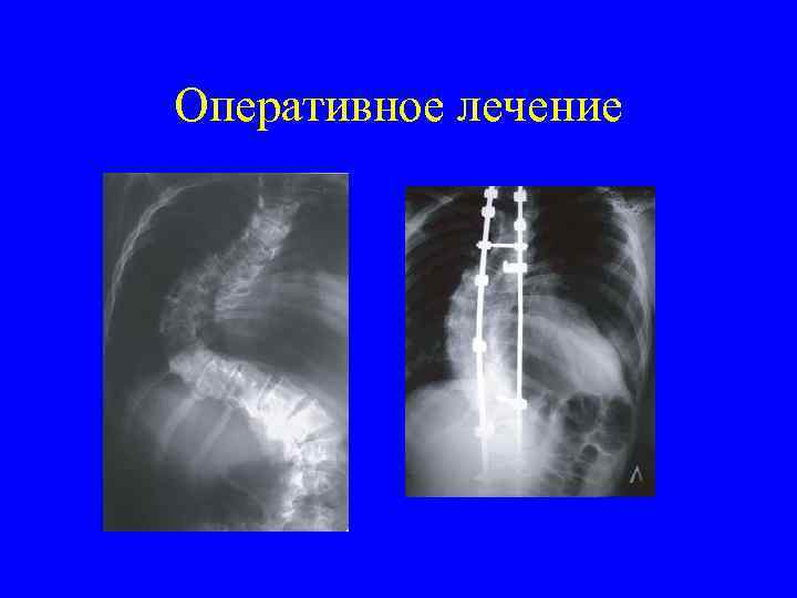 Оперативное лечение 