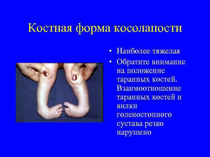 Костная форма косолапости • Наиболее тяжелая • Обратите внимание на положение таранных костей. Взаимоотношение