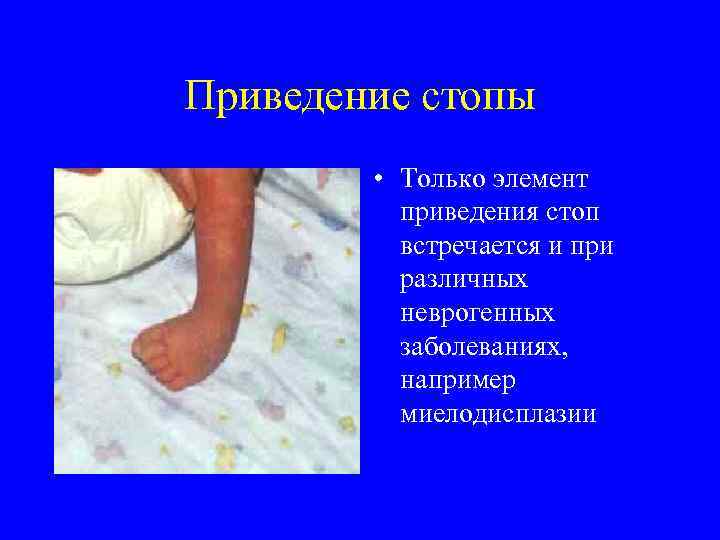 Приведение стопы • Только элемент приведения стоп встречается и при различных неврогенных заболеваниях, например
