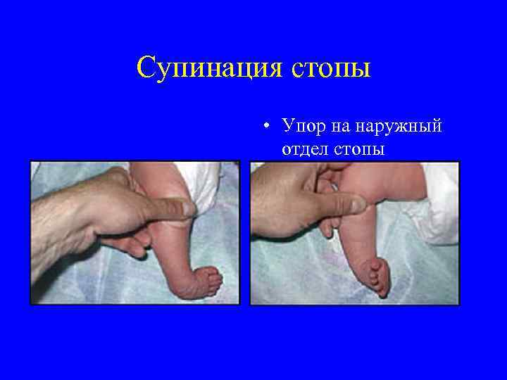 Супинация стопы • Упор на наружный отдел стопы 