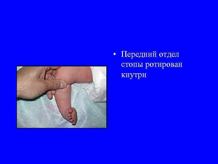  • Передний отдел стопы ротирован кнутри 