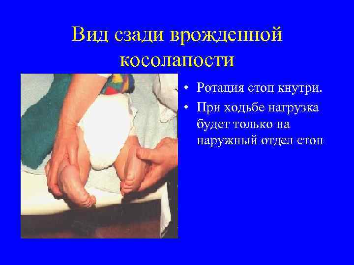 Вид сзади врожденной косолапости • Ротация стоп кнутри. • При ходьбе нагрузка будет только