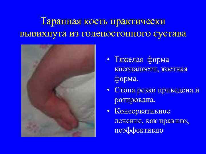 Таранная кость практически вывихнута из голеностопного сустава • Тяжелая форма косолапости, костная форма. •