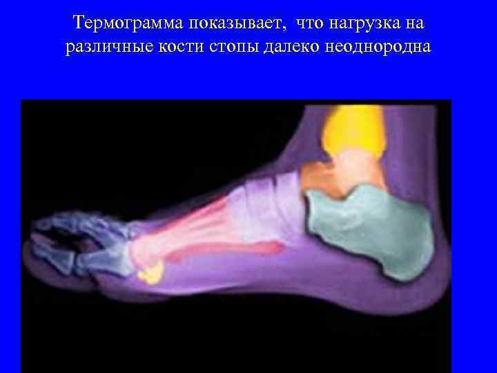 Термограмма показывает, что нагрузка на различные кости стопы далеко неоднородна 